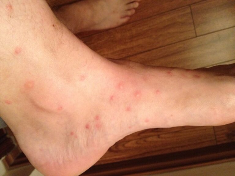 Flea bites on a human ankle